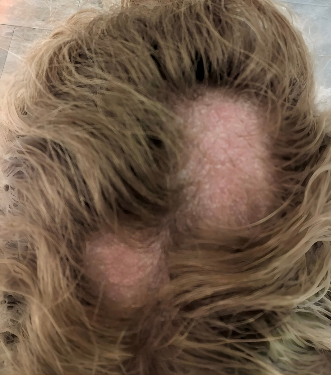 Caring for Hair During Alopecia Areata – How Natural Support Complements Treatment